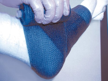 Cast Tape Delta-Lite Plus Fiberglass / Resin