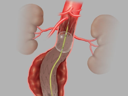 LP Balloon Catheters