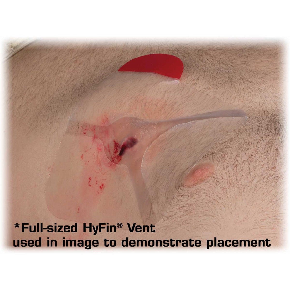 Hyfin Vent Compact Chest Wound Seal 4-3/4 x 4-3/4 Inch, 2 per Pack