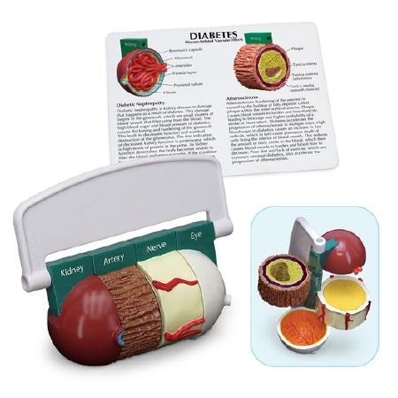 Diabetes Model