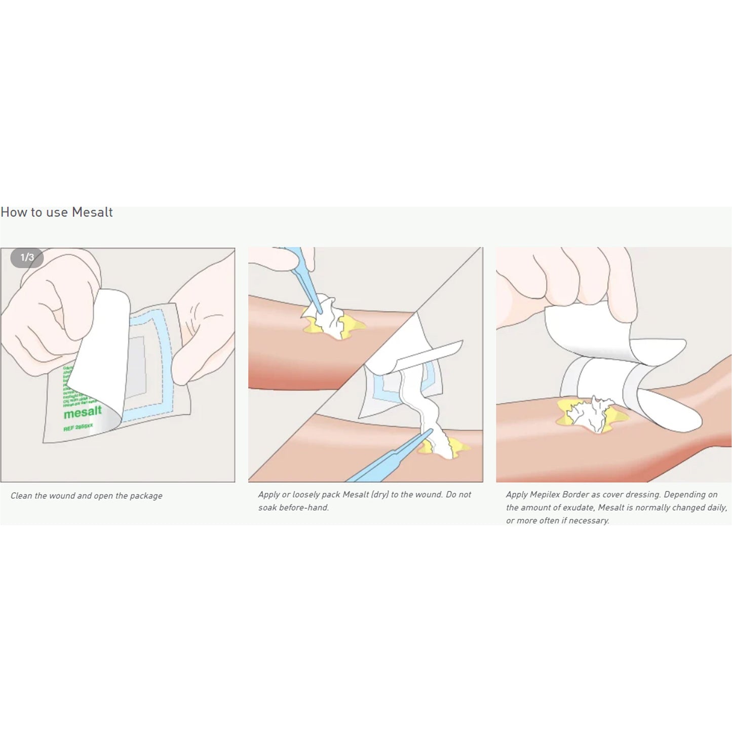 Mesalt Sodium Chloride Impregnated Dressing 6 x 6 Inch (3 x 3 Inch Folded) Sterile Gauze