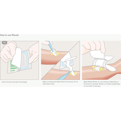 Mesalt Sodium Chloride Impregnated Dressing 6 x 6 Inch (3 x 3 Inch Folded) Sterile Gauze