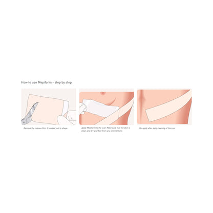 Mepiform Silicone Scar Sheeting 1.6 x 12 Inch Strip