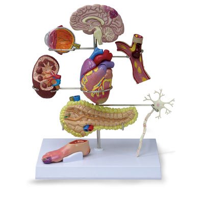 Type 2 Diabetes Model