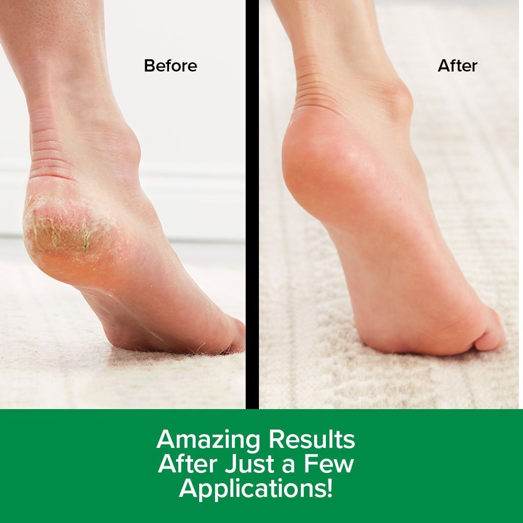 Hempvana Heel Tastic Intensive Heel Repair Therapy for Dry, Cracked Heels